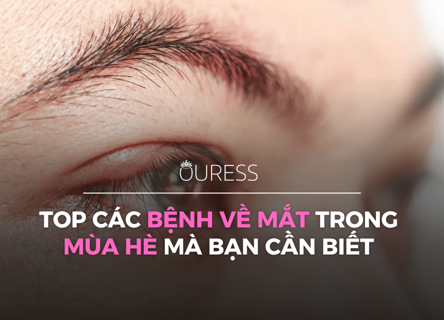 Top các bệnh về mắt thường gặp trong mùa hè mà bạn cần biết