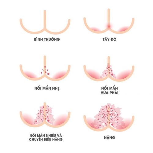 5 cấp độ hăm tã ở trẻ nhỏ