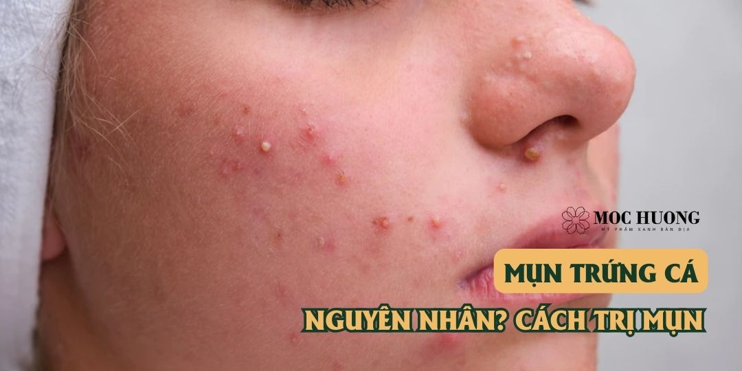 Mụn trứng cá: nguyên nhân đến từ đâu? Cách trị mụn trứng cá tại nhà