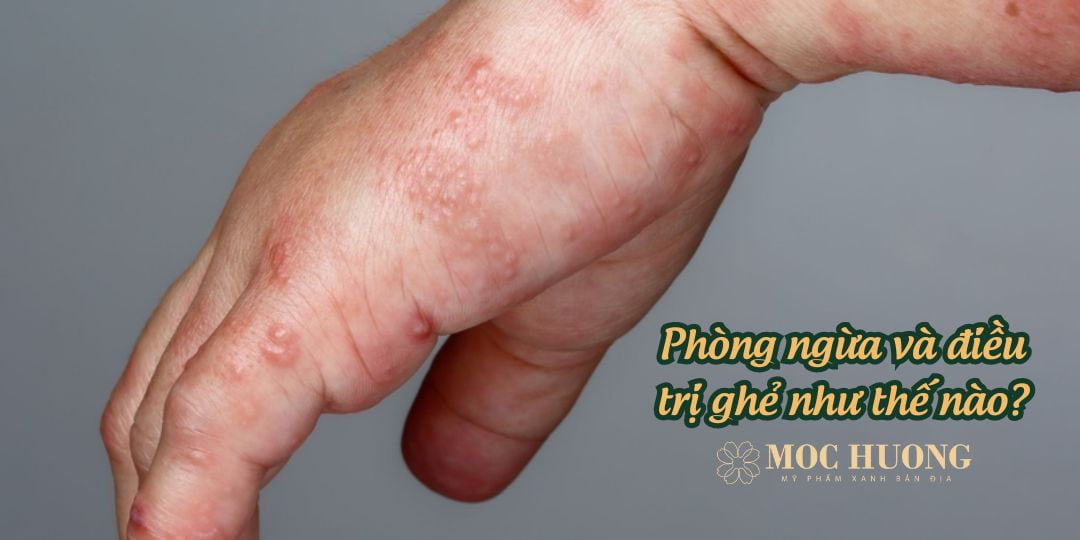 Ghẻ là gì? Nguyên nhân bị ghẻ và các phương pháp phòng ngừa, điều trị
