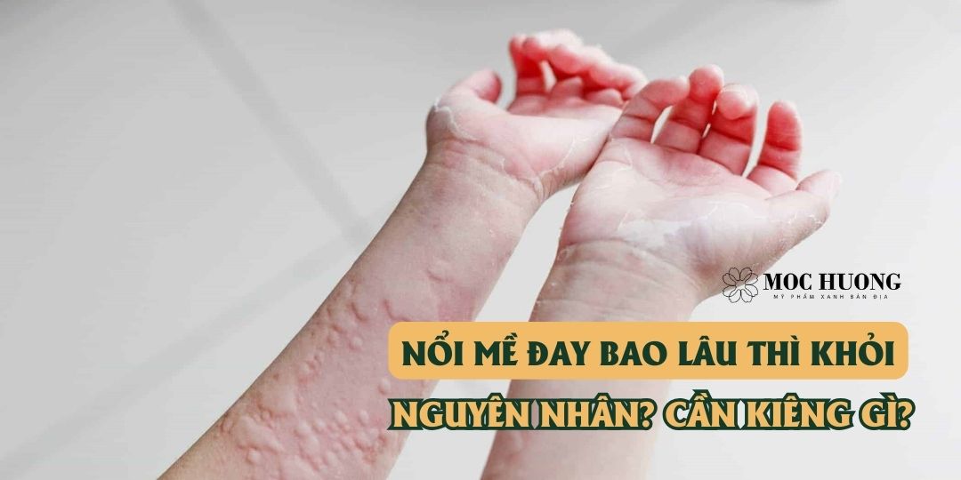 Nổi mề đay bao lâu thì khỏi? nguyên nhân do đâu? cần kiêng gì?