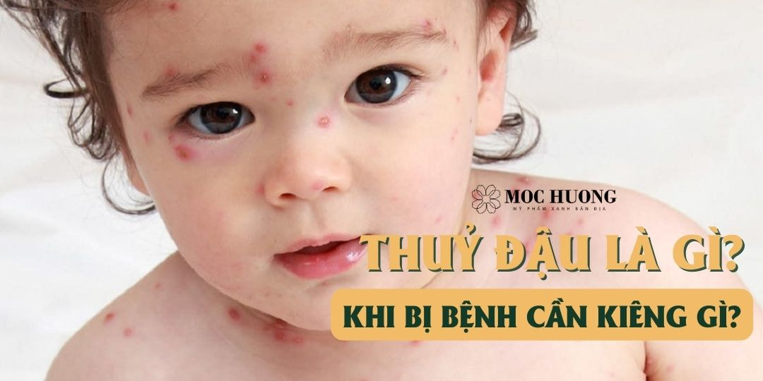 Thuỷ đậu là gì? Khi bị bệnh thuỷ đậu cần kiêng gì? Cách chữa và điều trị tại nhà