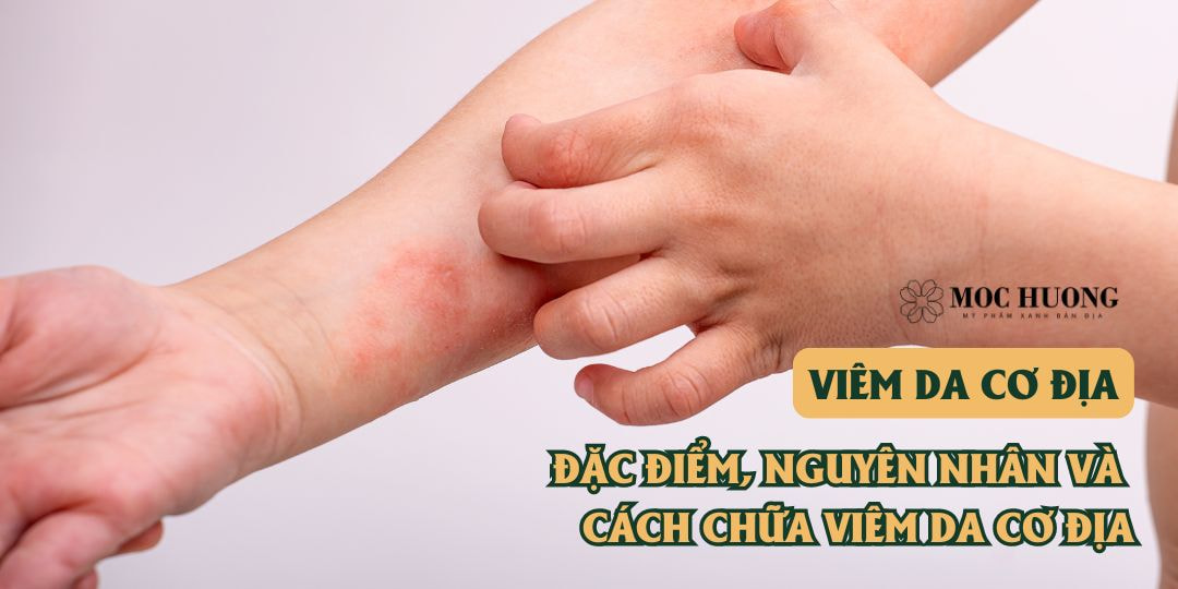 Viêm da cơ địa: Đặc điểm, nguyên nhân và cách chữa viêm da cơ địa