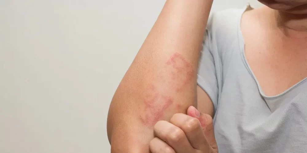 3 bệnh da liễu khó chịu nhất và cách phòng ngừa