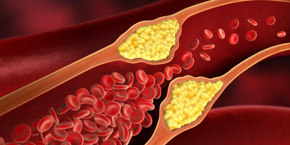 Bệnh mỡ máu cao nguy hiểm ra sao, điều trị thế nào?