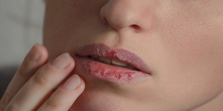 Phục hồi môi khô nứt nẻ với cách đơn giản nhất
