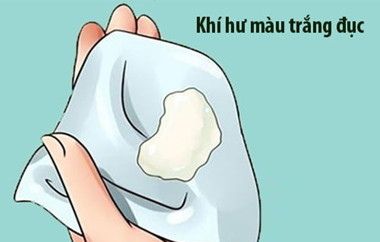 Khí hư có màu trắng đục hoặc vàng là biểu hiện của viêm phụ khoa