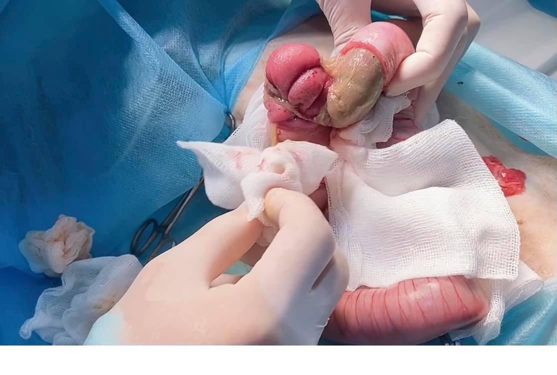 Phẫu thuật cắt đoạn ruột bị hoại tử .