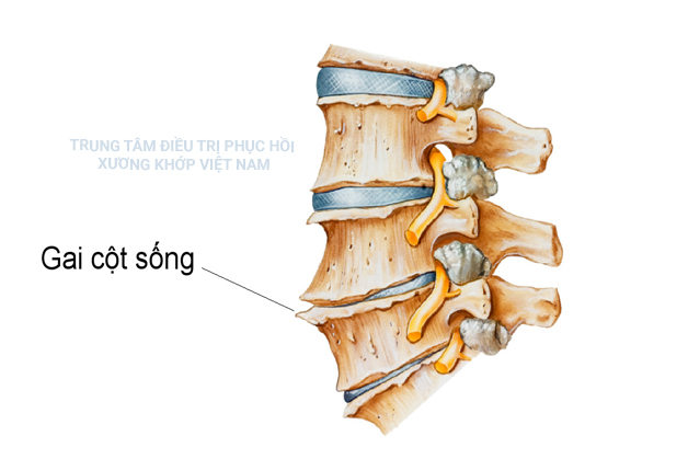 7 Ngày đánh bay lo lắng bệnh gai cột sống