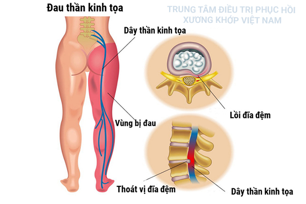 Bật mí phương pháp trị đau thần kinh tọa hiệu quả