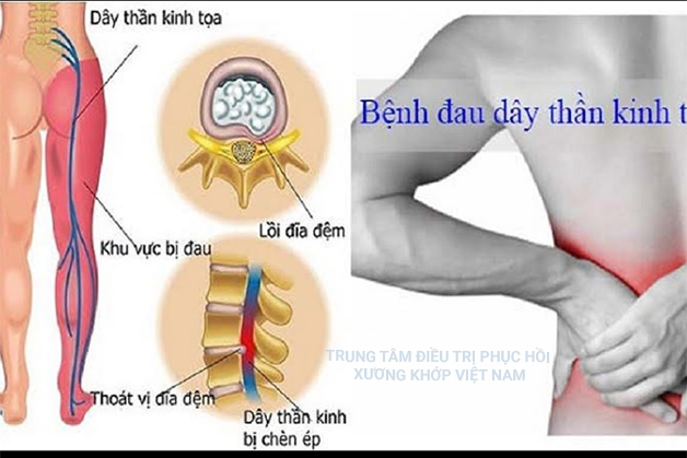 Chữa khỏi đau thần kinh tọa sau 3 liệu trình sử dụng thuốc