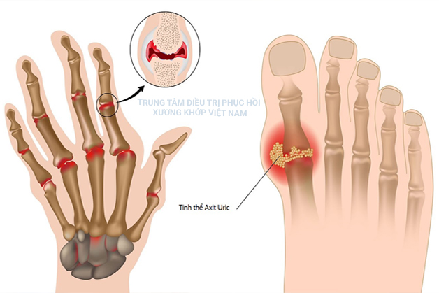 Tổng hợp các nguyên nhân gây bệnh Gout mà không phải ai cũng biết