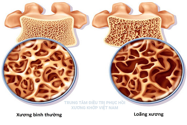 Biến chứng Loãng xương do bệnh Tiểu đường