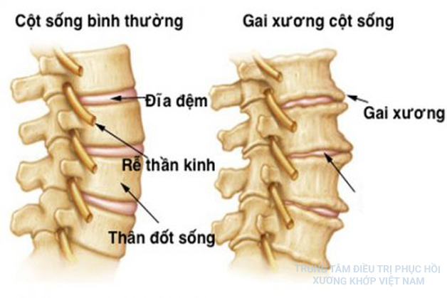 Chia sẻ các mẹo trị gai cột sống tại nhà