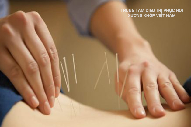 Tác dụng của châm cứu trong điều trị bệnh lý cơ xương khớp