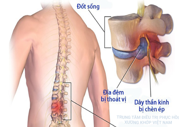 Dấu hiệu đau lưng là bị sao? Cách điều trị hiệu quả và an toàn tuyệt đối