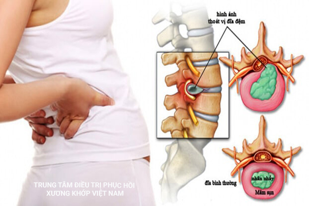 Đau lưng là triệu chứng báo hiệu bệnh lý gì?