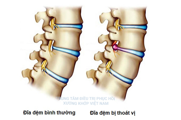 Thoát vị đĩa đệm là bệnh gì? Có chữa được không?