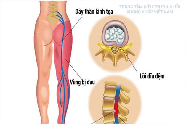 Điều trị đau thần kinh toạ theo y học cổ truyền