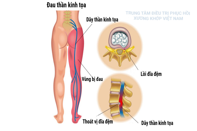 Điều trị dứt điểm đau Thần kinh tọa trong 2 tháng