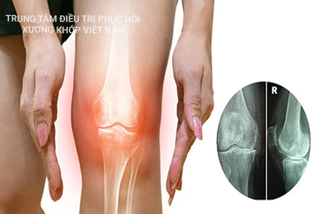 Điều trị Gout hiệu quả tại nhà