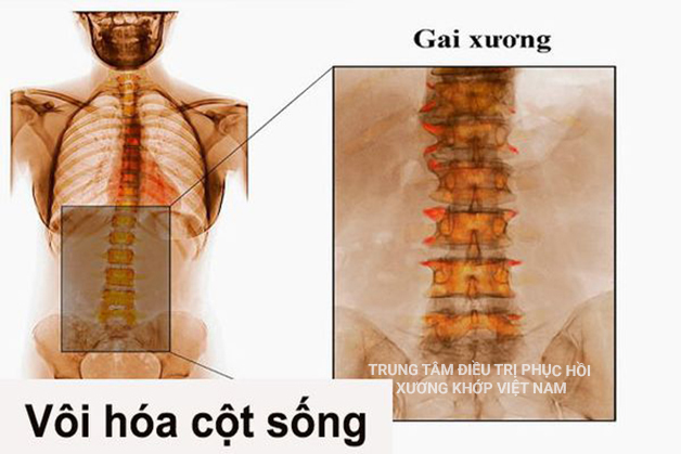 Điều trị hiệu quả sau 7 ngày bệnh vôi cột sống