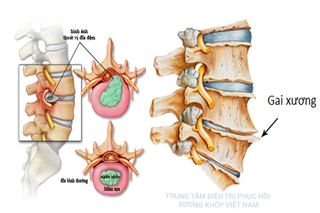 Giật mình trước các biến chứng gai cột sống