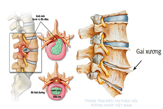 Gai cột sống và cách chữa trị dứt điểm