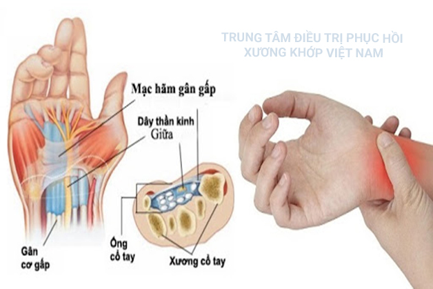 Một số bệnh lý gây đau khớp cổ tay