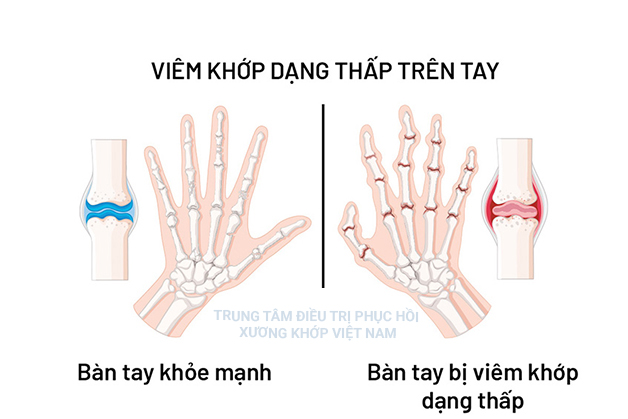 Khỏi ngay viêm đa khớp dạng thấp