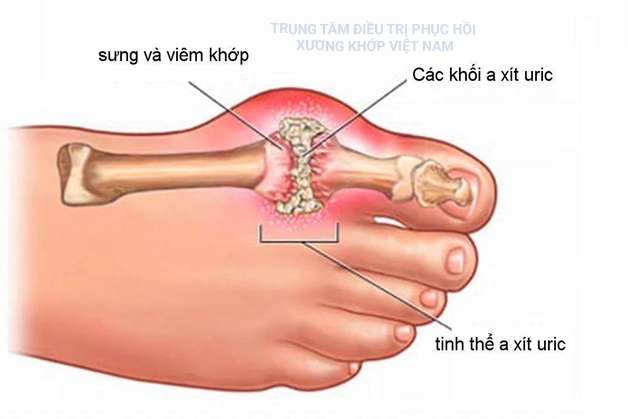 Nguyên nhân và cách điều trị bệnh Gout hiệu quả, an toàn