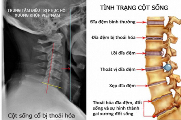 Nguyên nhân và chẩn đoán thoát vị đĩa đệm?