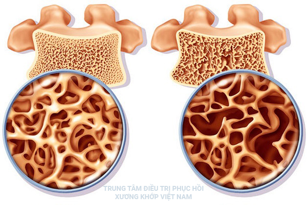 Những ai cần phải đánh giá mức độ loãng xương?