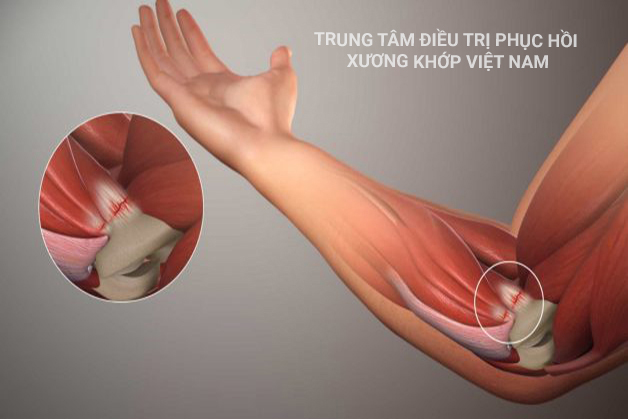 Những nguy hiểm từ đau đầu gối, khuỷu tay mà bệnh nhân không nên bỏ qua