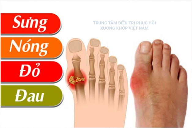 Những nguyên nhân gây bệnh Gout có thể bạn chưa biết