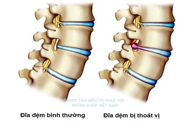 Phòng tránh thoát vị đĩa đệm như thế nào?