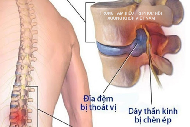 Thoát vị đĩa đệm và những chỉ định ngoại khoa