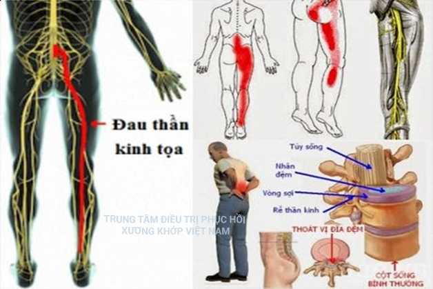 Tìm hiểu đau thần kinh tọa theo y học cổ truyền