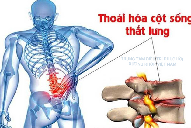 Triệu chứng của thoái hóa cột sống, phương pháp điều trị như nào?