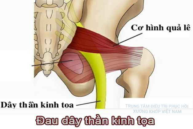 Triệu chứng và điều trị đau thần kinh toạ theo y học hiện đại