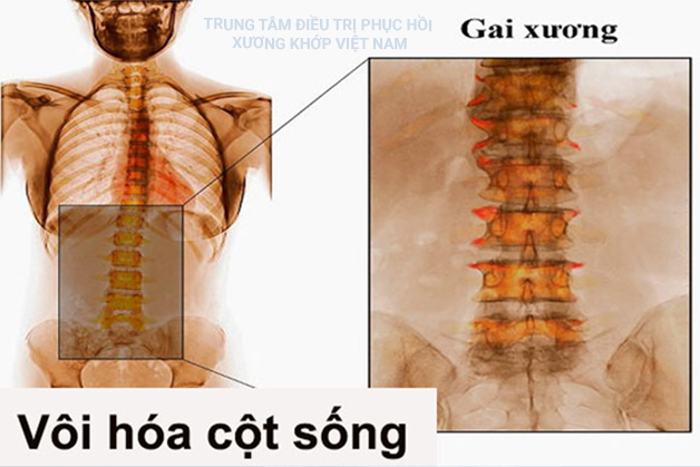 Chữa khỏi Vôi cột sống trong 1 tháng