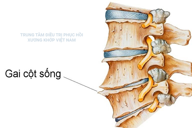 Bệnh Gai cột sống