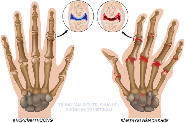 Bàn tay bị viêm đa khớp