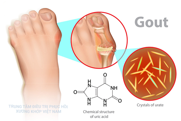 Bệnh Gout