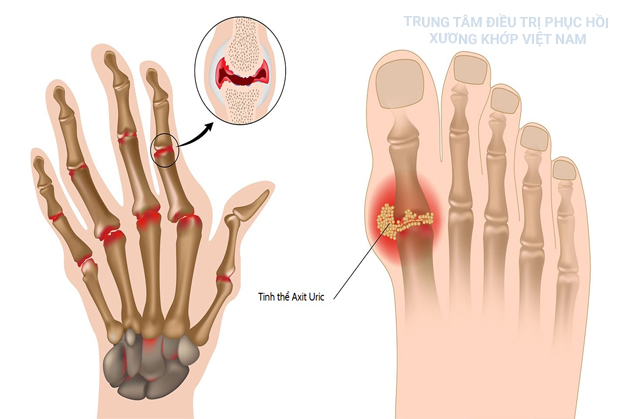 Bệnh Gout