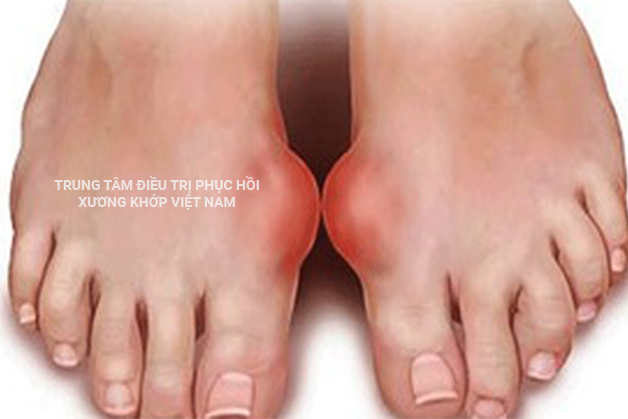 Bệnh Gout