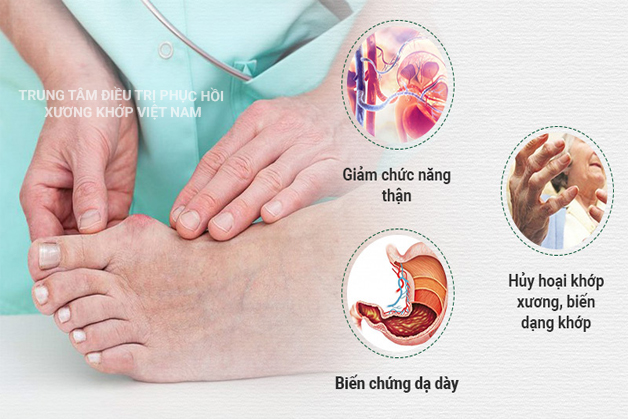 Bệnh Gout gây ra nhiều biến chứng nguy hiểm