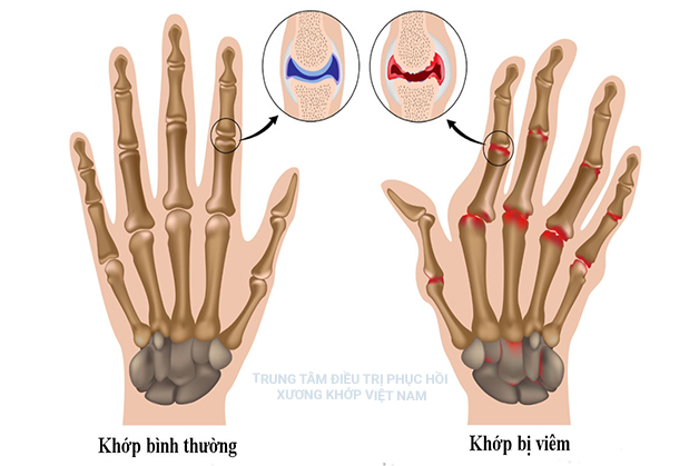  Bệnh Viêm đa khớp dạng thấp