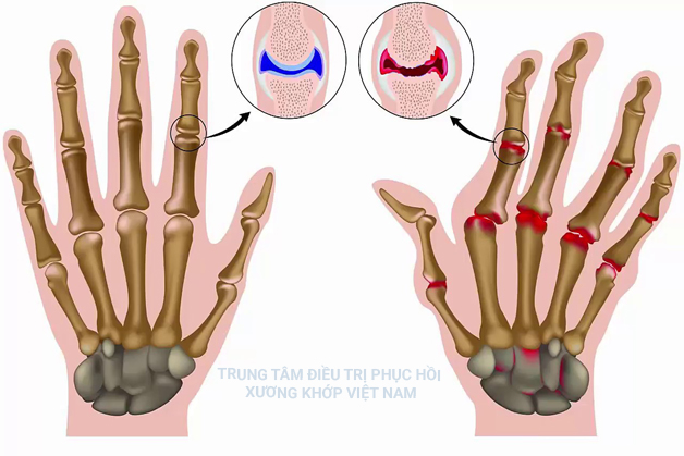 Bệnh Viêm đa khớp dạng thấp