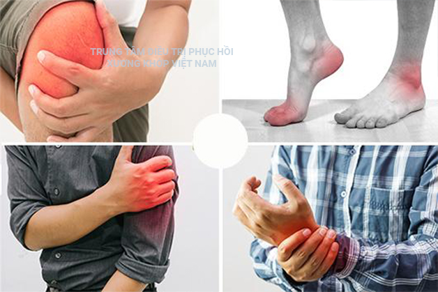 Bệnh viêm khớp phản ứng